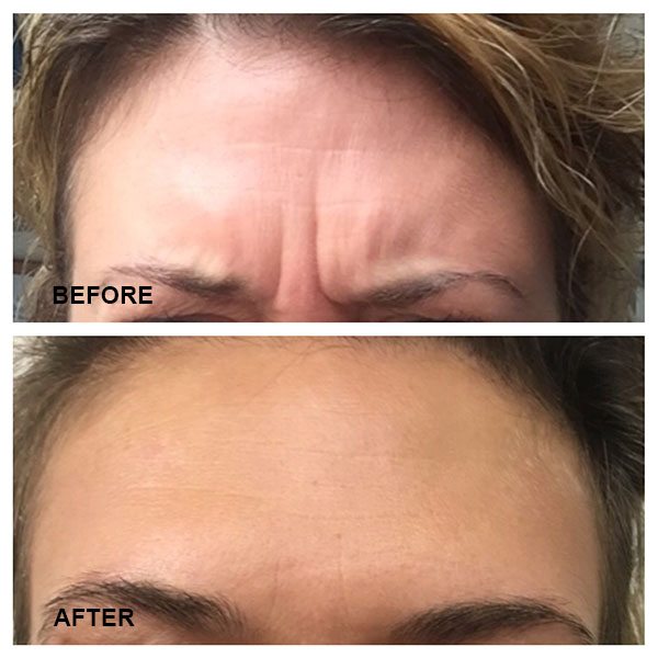 Botox Injections in Austin, TX Viva Day Spa & Med Spa