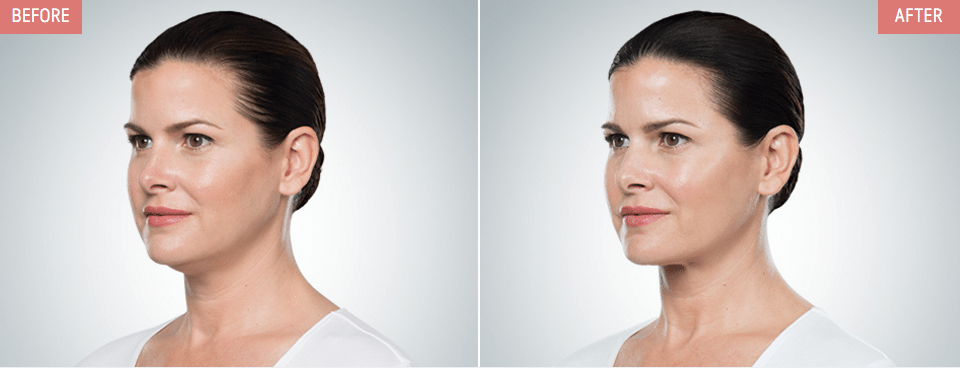 kybella fat injections dissolving chin before double treatment belkyra allergan thermiva surgery treatments injection plastic botox austin spa