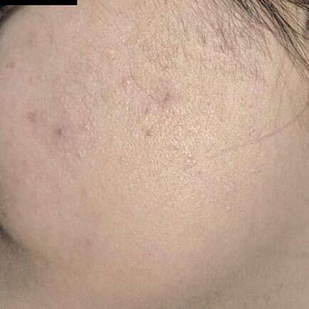 Significantly fewer facial hairs visible on woman's left cheek after laser hair removal treatment