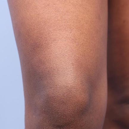 No visible leg hair remains on female leg after 5 laser hair removal treatments