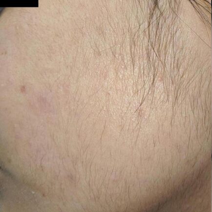 Hair is visibly noticeable on woman's left cheek before laser hair removal treatment