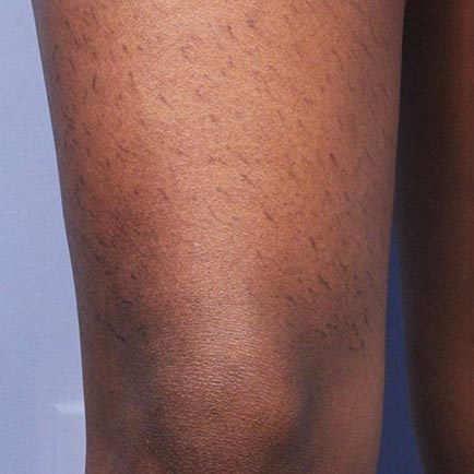 Image of right thigh with hair before laser hair removal