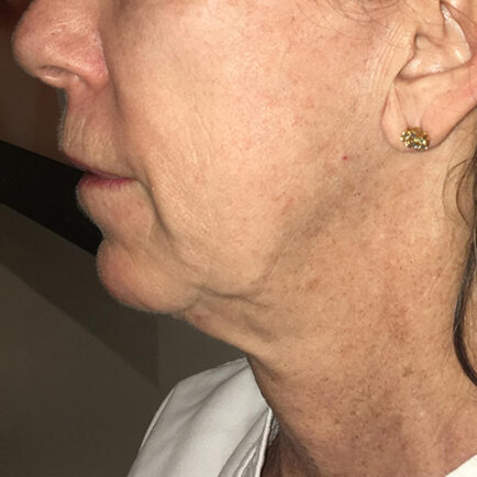 Photo of woman's face and image after RF Microneedling
