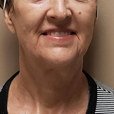 After photo of woman's face and neckline after RF microneedling