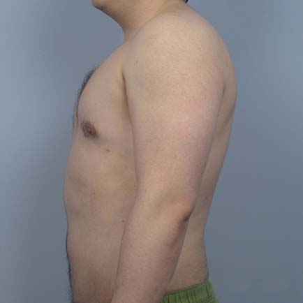 Profile image of a man's stomach after receiving body contouring treatments.