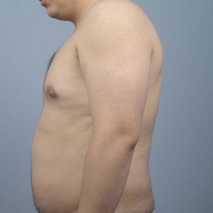 Profile image of a man's stomach before BodyFX body contouring