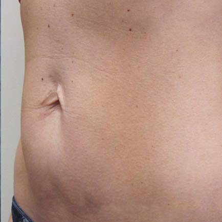 45-degree profile image of a woman's stomach after body contouring by BodyFX