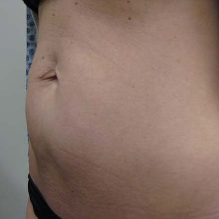 Side profile of a woman's abdomen before BodyFX treatment