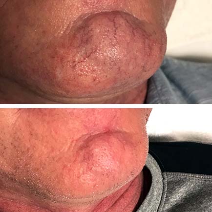 Close-up image of a male chin before and after IPL photofacial with improved appearance of spider veins.
