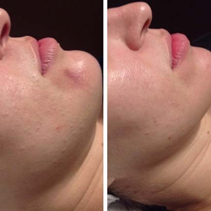 Side profile of a woman's face showing difference in complexion and redness before and after microneedling by SkinPen.