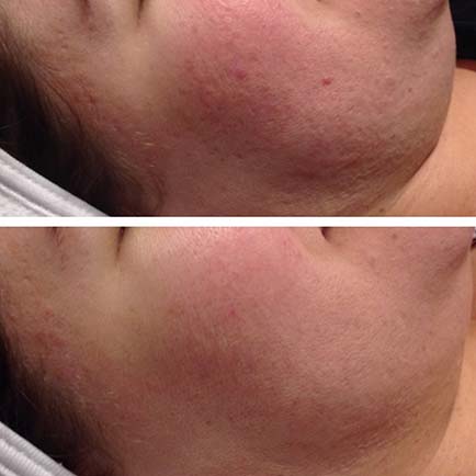 Side profile of a female face with reduced redness and improved tone before and after microneedling treatments.
