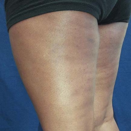 Reduced appearance of cellulite on the back of a woman's legs post BodyFX body sculpting sessions.