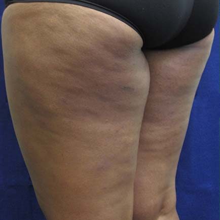 Cellulite on African-American woman's thighs before BodyFX treatment