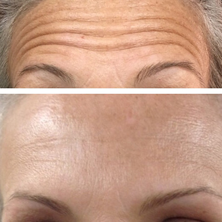 Woman's forehead showing erased appearance of deep forehead lines before and after Dysport injections.