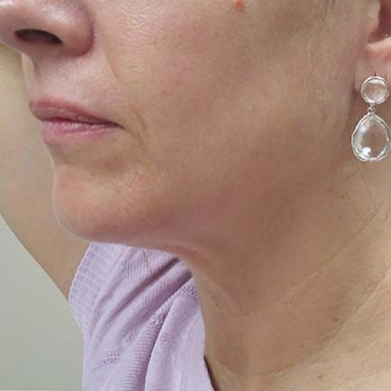 Side profile of woman's face and neck with improved results after skin tightening.