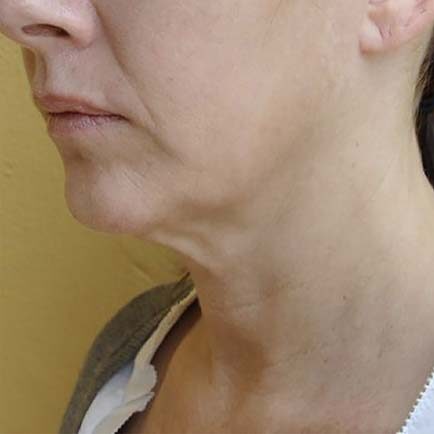 Face and neck of a woman with sagging skin before skin tightening.