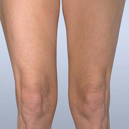 Dramatically improved tone and tightness of the skin above the knees of a woman after Forma skin tightening.