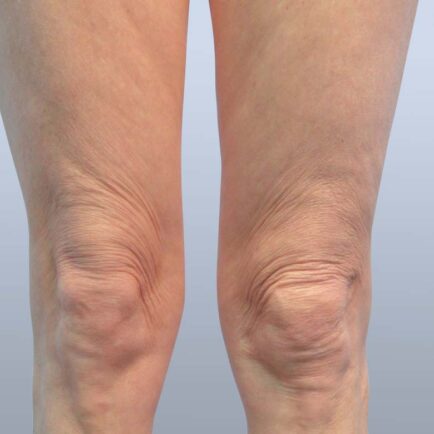 Lax, sagging skin above the knees of a woman before skin tightening treatments.