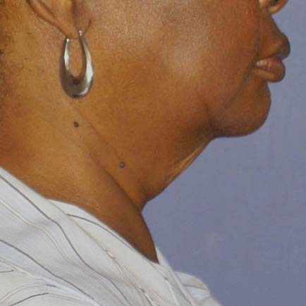 Right-facing side profile of a the sagging skin on a woman's neck before skin tightening treatments.