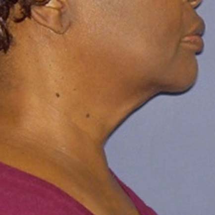 Profile of a woman's tighter, toner neck after Forma skin tightening.