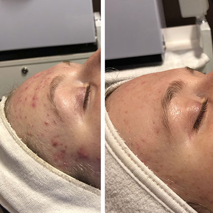 Woman's forehead with severe acne with improvement after Hydrafacial treatments.