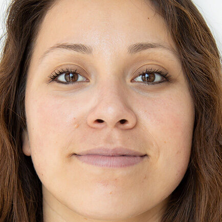 Woman's face with less redness, more brightness, and no congestion after a HydraFacial.