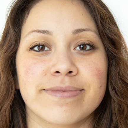 Close-up of a woman's face with congestion and redness before HydraFacial.
