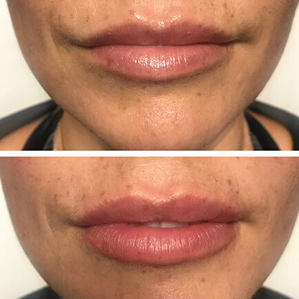 Lips of a female before and after receiving Juvderm lip filler injections.