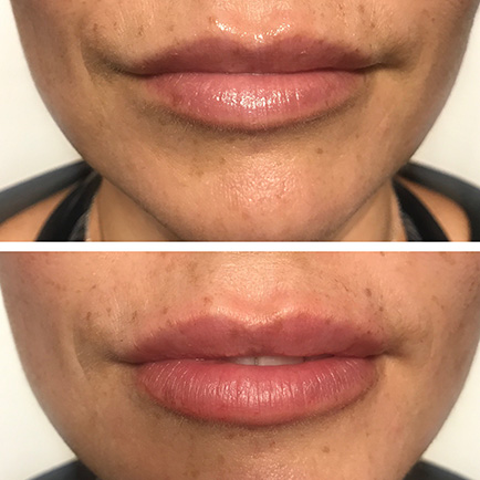 Lips of a female before and after receiving Juvderm lip filler injections.