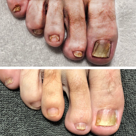 Before and after photo of a man's toenails on his right foot after a single laser toenail fungus removal session. Improved nail bed and less infection.