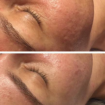 A woman's face in before and after photos showing improved texture from microneedling.