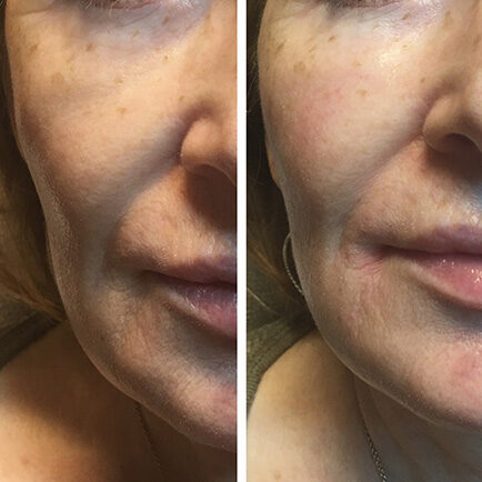 Woman's face before and after receiving Restylane cheek filler treatments.