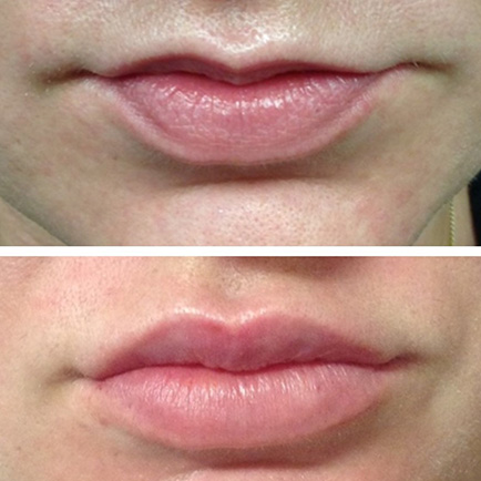 Before and after image showing a woman's plumper, more defined lips after Restylane lip filler injections.
