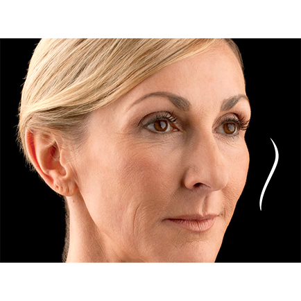 Woman's face highlighting improved contour and volume in her cheeks after Voluma cheek filler.
