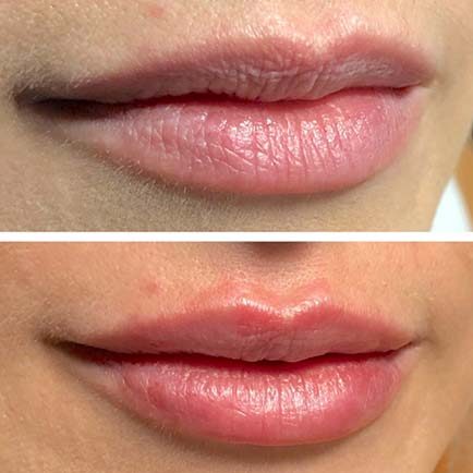 A woman's lips before and immediately after Volbella