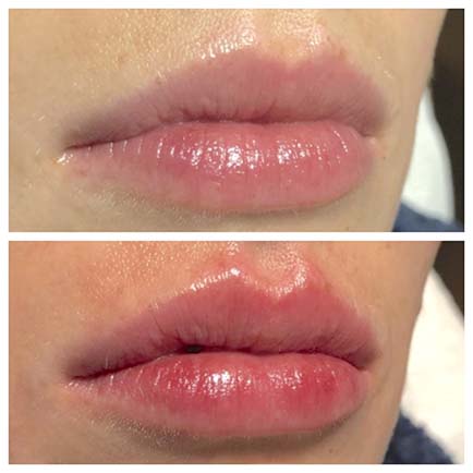 A woman's lips before and immediately after Volbella lip filler treatments.