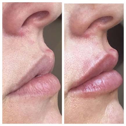 Before and after photo of a woman's lips showing subtle improvement after Volbella lip filler treatments.