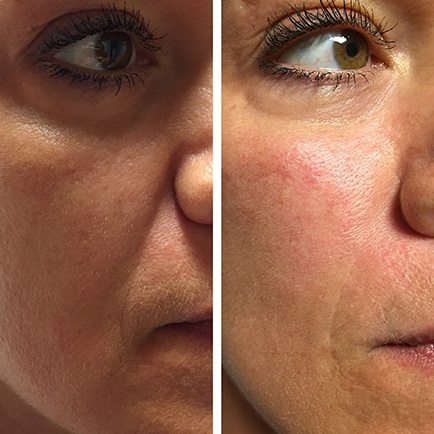 Voluma Injections & Treatments in Austin, TX | Viva Day Spa | Cheek Filler