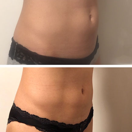 Woman's stomach before and after body contouring treatments, highlighting improved contour and fat reduction.