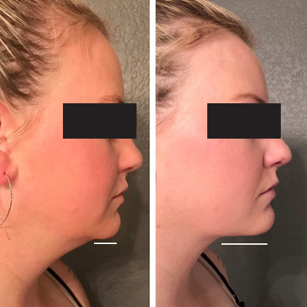 Side profile before and after image of a woman's improved chin contour after Kybella double chin treatment