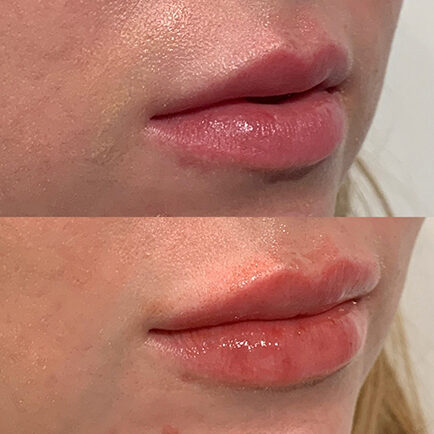 Woman's lips before and after Restylane lip filler at Viva Day Spa + Med Spa.
