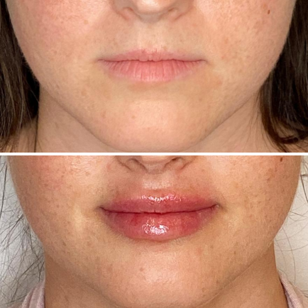 Before and after photo of Kysse lip filler treatment