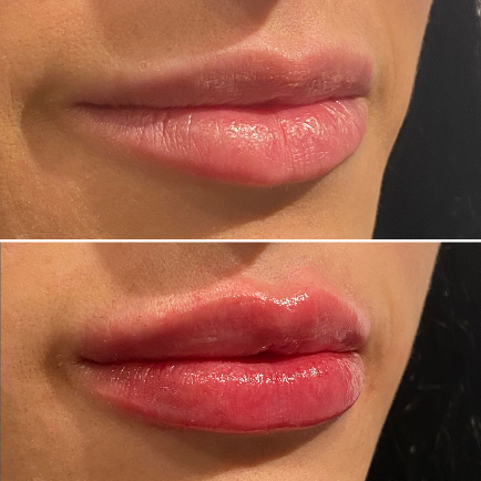 Restylane Defyne before and after photo of a female patient at Viva Day Spa + Med Spa in Austin, immediately post-injection