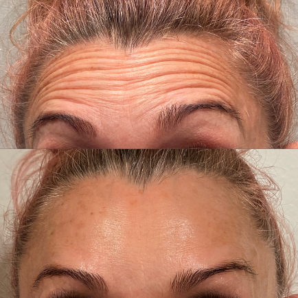 Woman's forehead wrinkle and liness before and after Dysport injections.