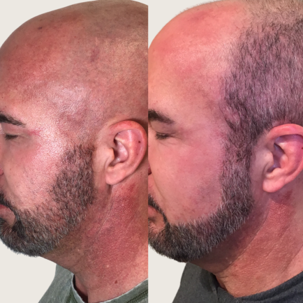 Male Before and After IPL Photofacial for Vascular Lesions on the neck and faceat Viva Day Spa