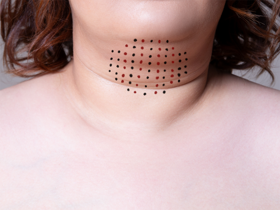 Woman's neck and double chin with injection grid for Kybella.