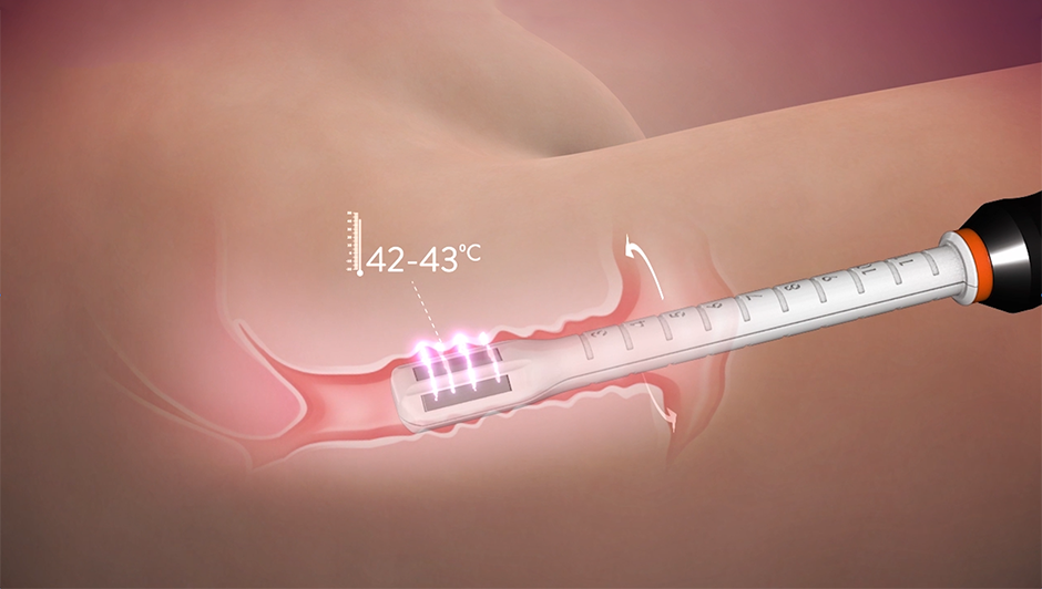 Illustration of internal vaginal remodeling utilizing Radiofrequency energy during a Votiva vaginal rejuvenation treatment.