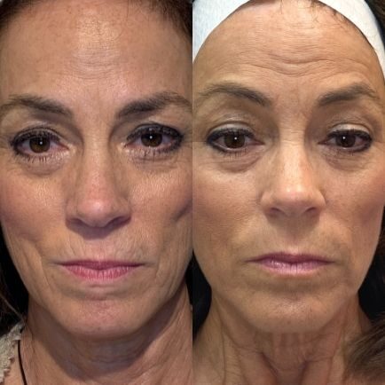 Sculptra before and after photo of a female patient after receiving two Sculptra filler treatments at Viva Day Spa + Med Spa in Austin..