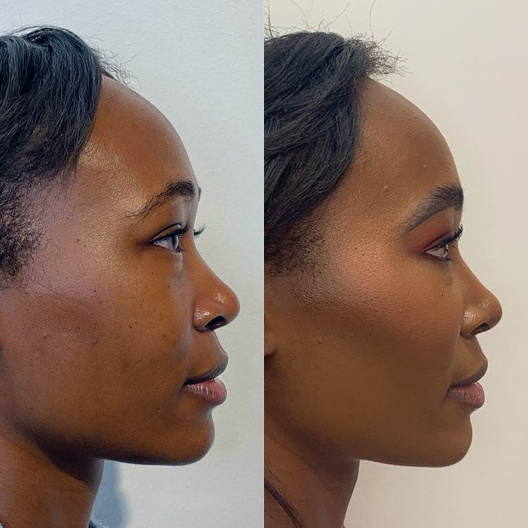 Viva Day Spa + Med Spa Facial Filler