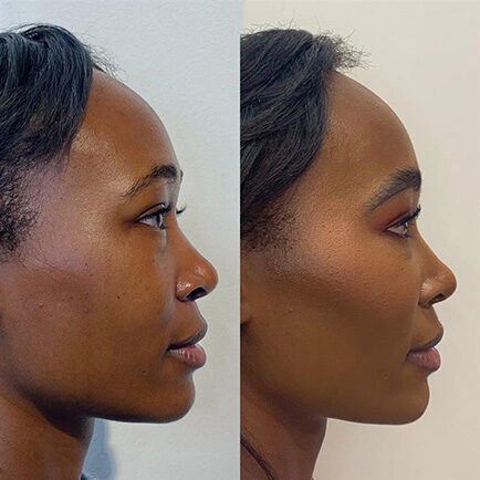 Patient before and after cheek filler injections at Viva Day Spa + Med Spa in Austin, Texas.